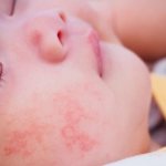 аллергические волдыри на щеках у ребенка