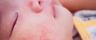 аллергические волдыри на щеках у ребенка