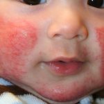 аллергический дерматит у ребенка