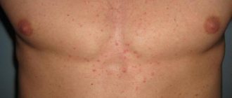 Аллергия на коже: красные пятна чешутся, лечение