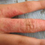 Аллергия на руках: виды, симптомы и лечение