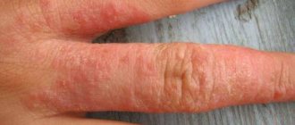 Аллергия на руках: виды, симптомы и лечение