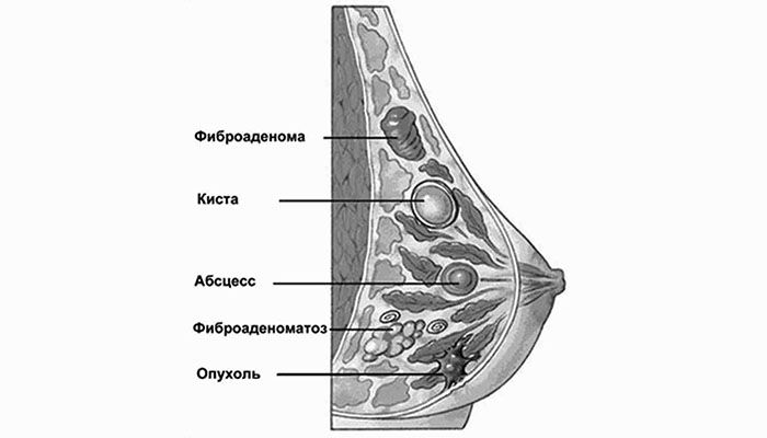Особенности и коррекция ареола соска ( груди ) у женщин