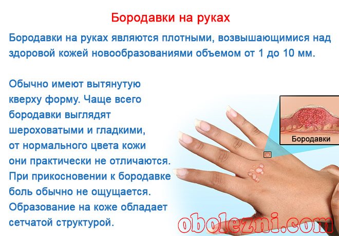 Бородавки на руках: причины, лечение, виды, как избавиться, фото, удаление