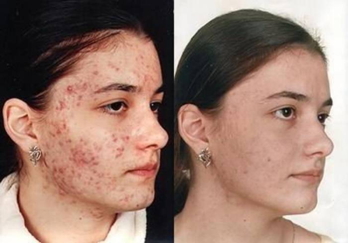 Лечение демодекоза лица: симптоматика и диагностика болезни