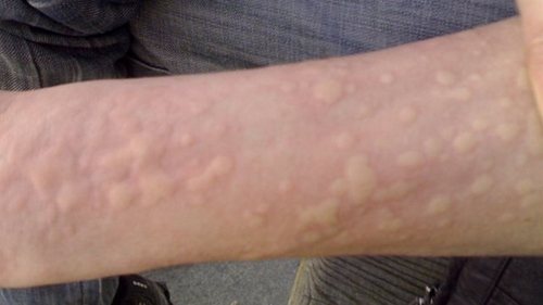 Холодовая крапивница: лечение по всем правилам