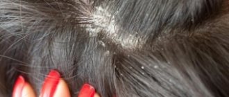 Лечение себореи кожи головы в домашних условиях