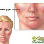 Покраснения на лице — симптомы розовых угрей