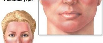 Покраснения на лице — симптомы розовых угрей