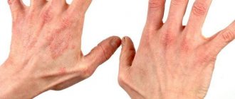 Проявления дерматита на коже рук