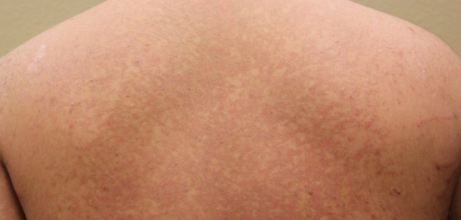 Цветной лишай. Причины, лечение цветного лишая в домашних условиях