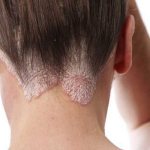 Сухая себорея кожи головы может стать огромной проблемой с эстетической стороны. Поврежденные участки кожи выглядят неприятно для окружающих и провоцируют появление комплексов у больного.
