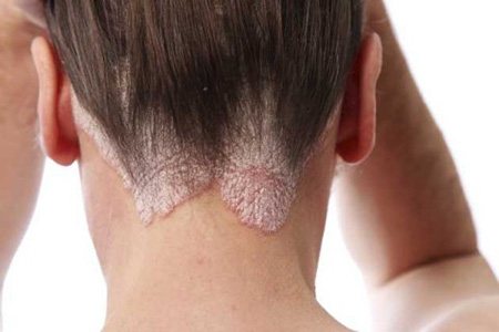 Сухая себорея кожи головы может стать огромной проблемой с эстетической стороны. Поврежденные участки кожи выглядят неприятно для окружающих и провоцируют появление комплексов у больного.