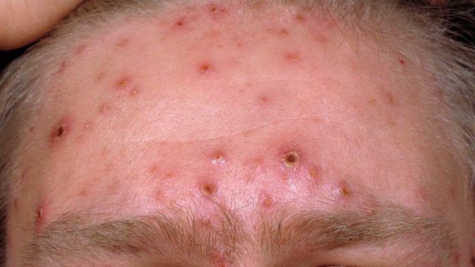 Ветрянка у взрослых: симптомы, лечение, фото