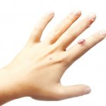Вирусная бородавка на пальце руки лечение 1